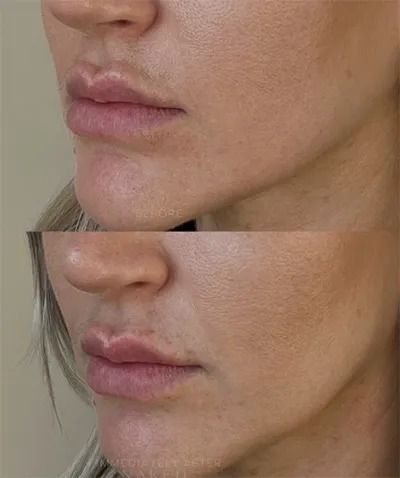 Before and after hyaluronidase injection.