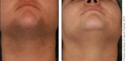 Before and after chin treatment comparison