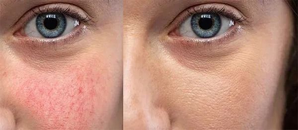 Before and after skin treatment comparison.