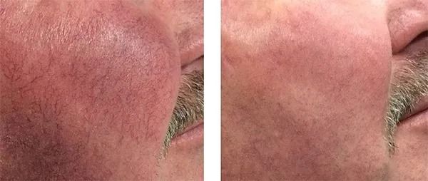 Before and after skin treatment comparison image.