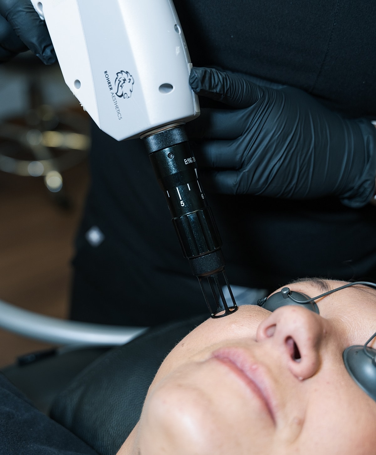 Microneedling procedure in a skin clinic setting.