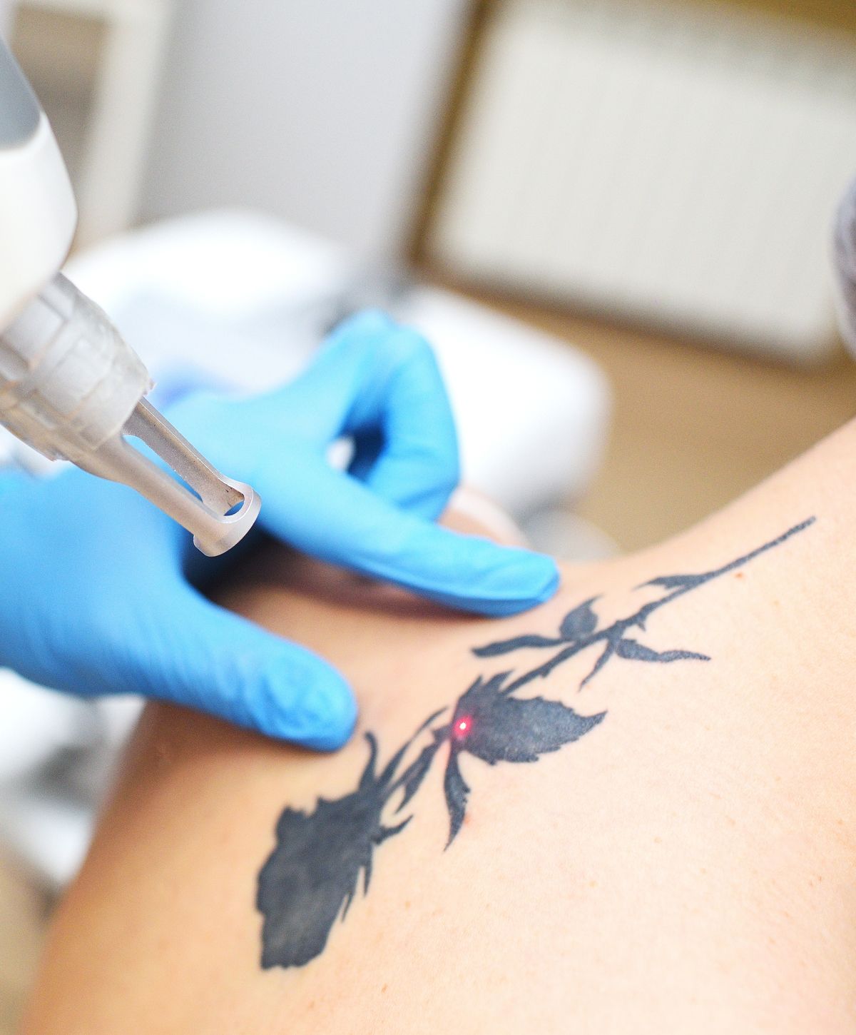 Laser tattoo removal in progress on skin.