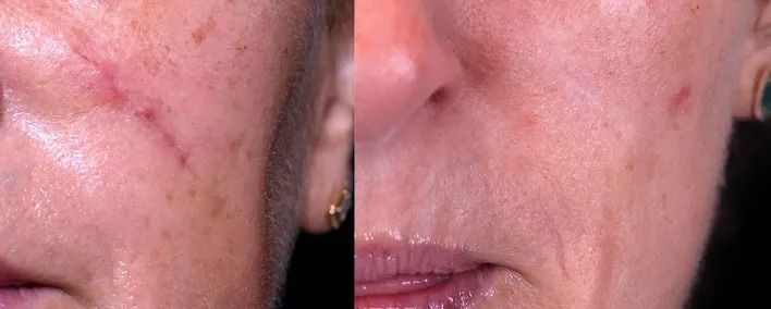 Before and after skin texture comparison.