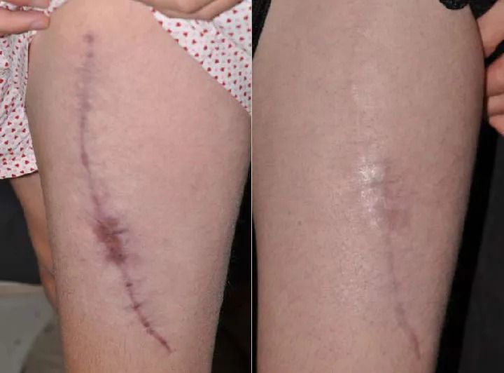 Before and after of a leg scar healing.