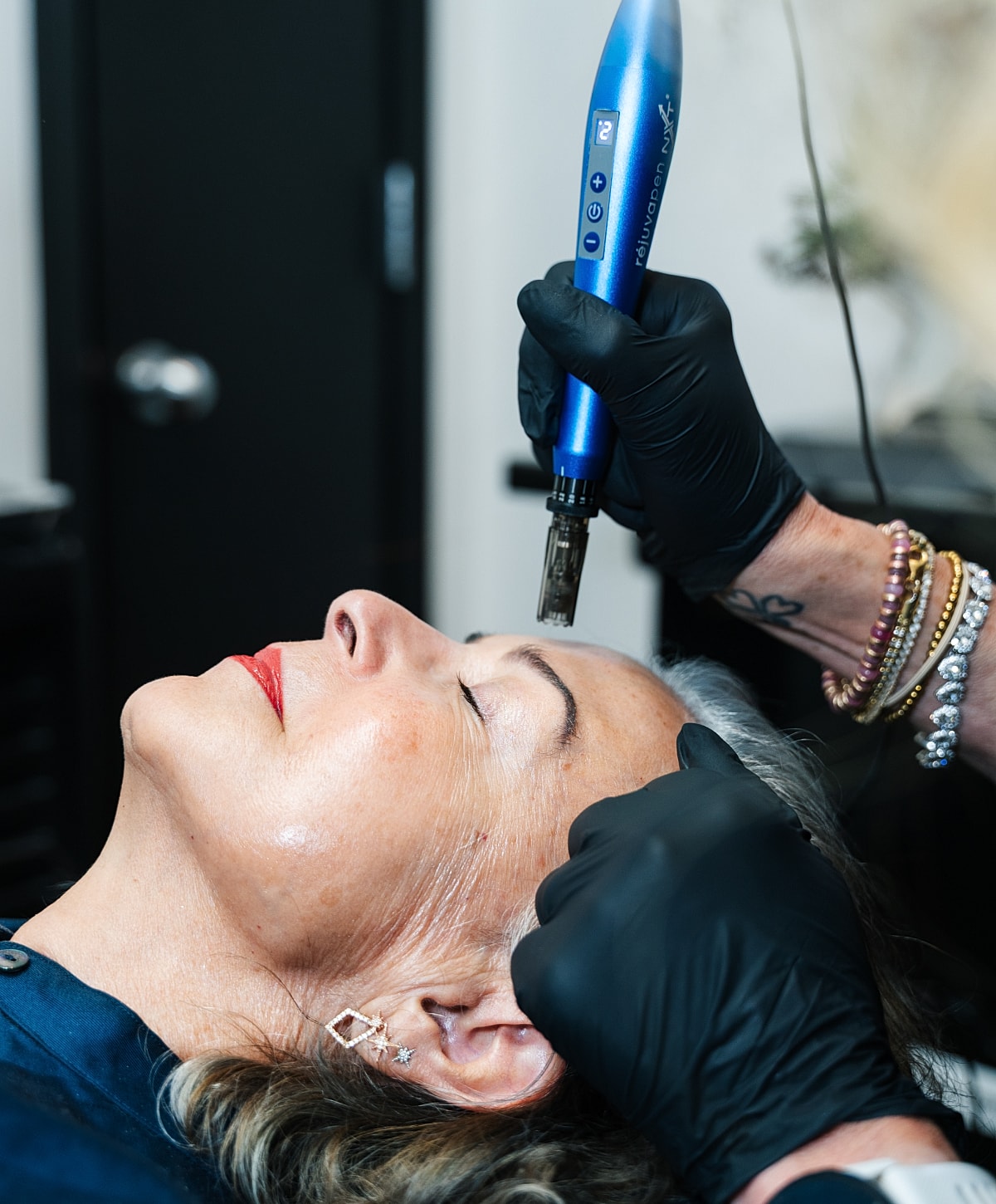 Microneedling procedure on a woman's face.