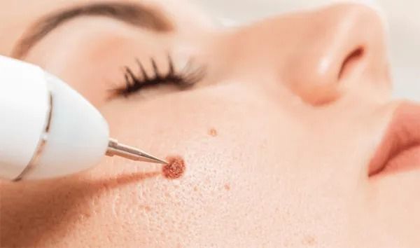 Skin treatment procedure on a woman's face.