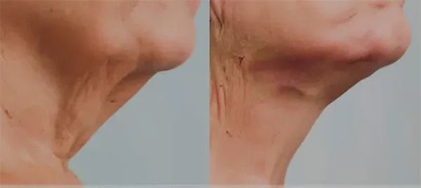 Before and after neck skin appearance comparison.