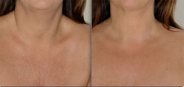 Before and after skin treatment comparison.