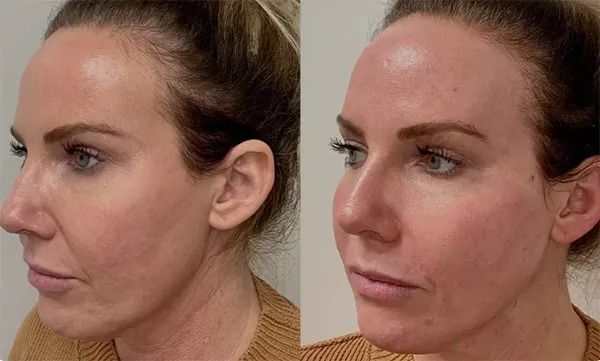 Before and after facial aesthetic treatments comparison.