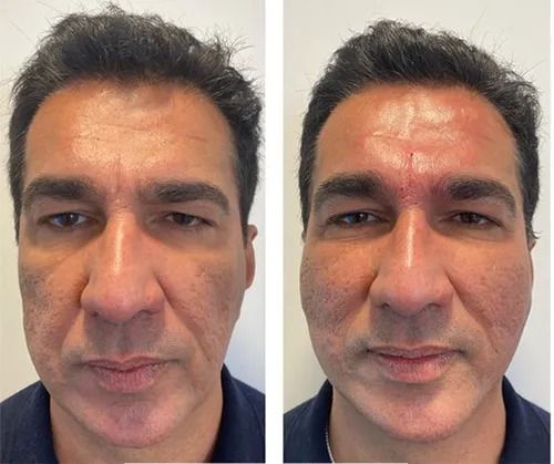 Before and after skin treatment comparison image.