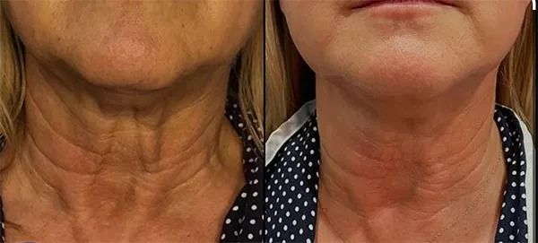 Comparison of neck appearance before and after treatment.