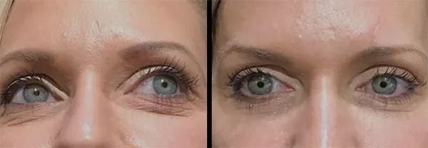 Before and after eye treatment comparison photos.