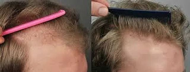 Comparison of hair styling techniques for thinning hair.