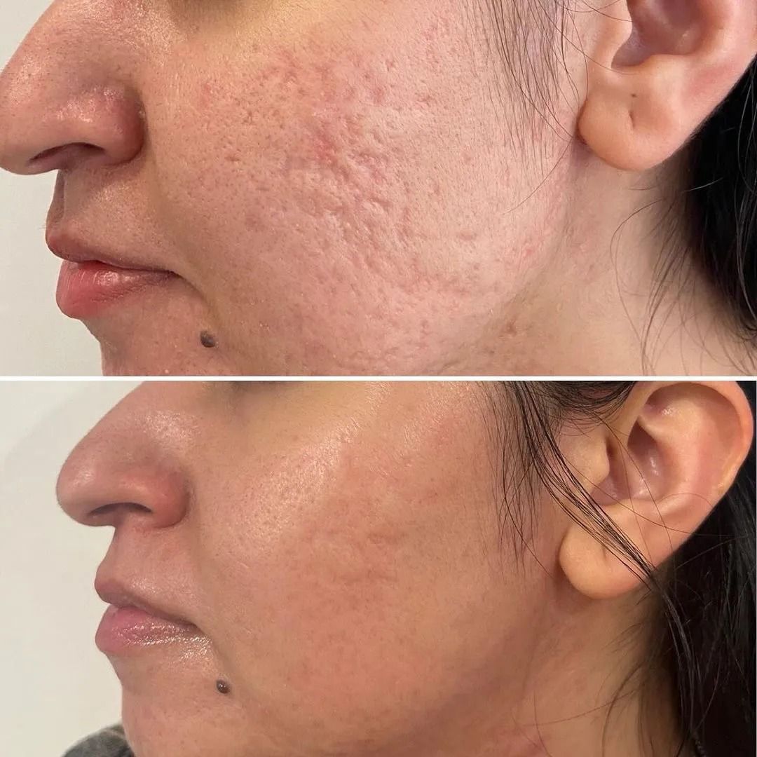 Before and after skincare treatment comparison.