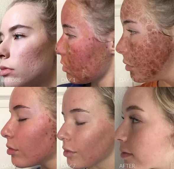 Skin treatment progress over eight days.