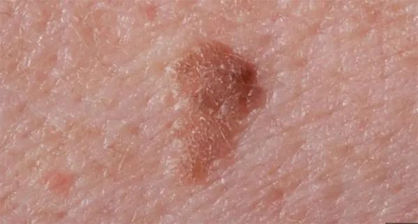 Close-up of skin with a growth or mole.