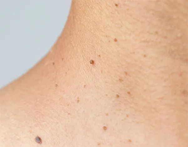 Close-up of skin with moles and freckles.