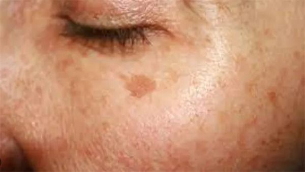 Close-up of skin with pigmentation and texture.