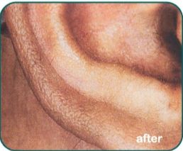 Laser Hair Removal Before & After