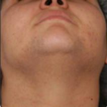 Laser Hair Removal Before & After