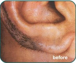 Laser Hair Removal Before & After