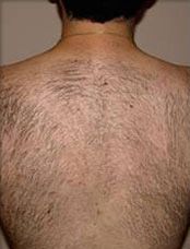Laser Hair Removal Before & After