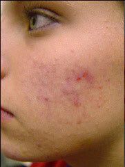 Clear Complexion Facial Before & After