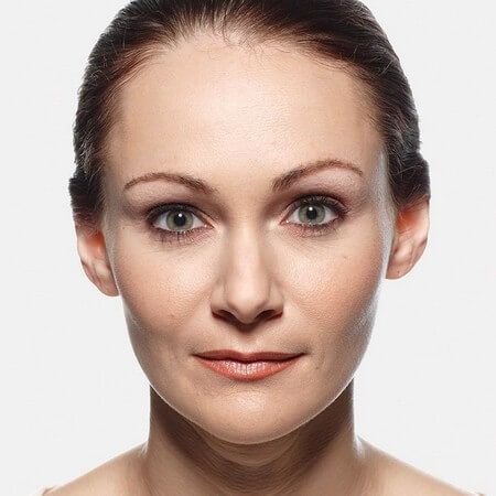 JUVÉDERM Before & After