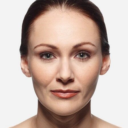 JUVÉDERM Before & After