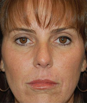 BioMedic / MicroPeel Before & After