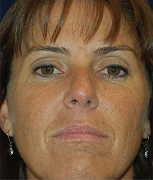 BioMedic / MicroPeel Before & After