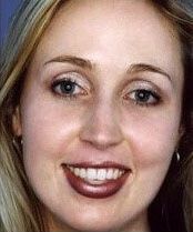 Deep Chemical Peel Before & After