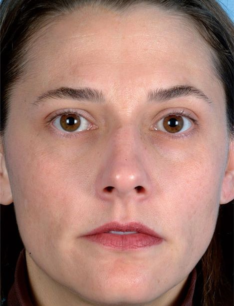 Microdermabrasion Before & After