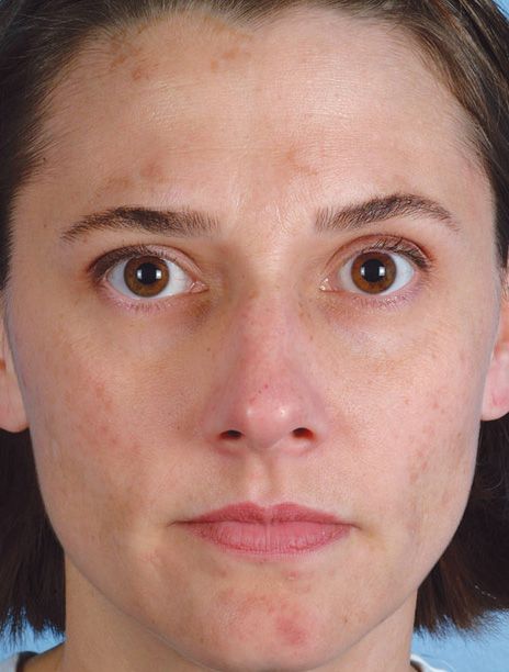 Microdermabrasion Before & After