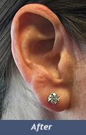 Earlobe Enhancement Before & After