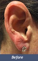 Earlobe Enhancement Before & After