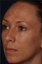 Vitalize Peel Before & After