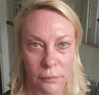 PRP Microneedling Before & After