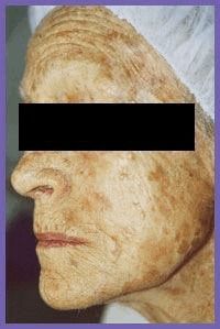 PRP Microneedling Before & After