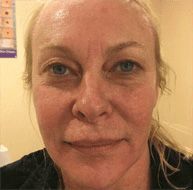 PRP Microneedling Before & After