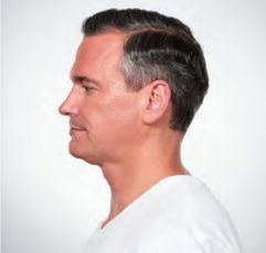 Non-Surgical Fat Removal Before & After