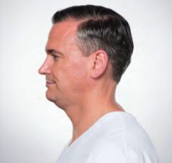 Non-Surgical Fat Removal Before & After