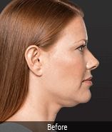 Non-Surgical Fat Removal Before & After