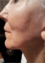 Vampire Facelift® Before & After