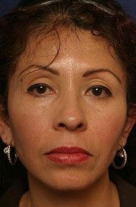 Vampire Facelift® Before & After