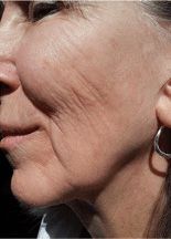 Vampire Facelift® Before & After