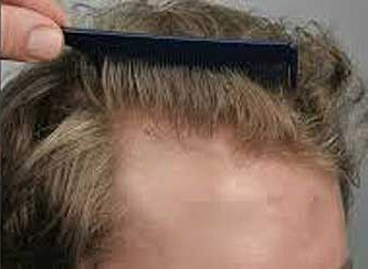 Hair Regrowth Treatment Before & After