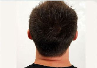 Hair Regrowth Treatment Before & After