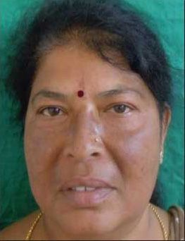 Microneedling Before & After