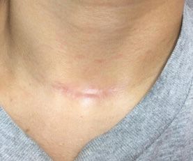 Microneedling Before & After